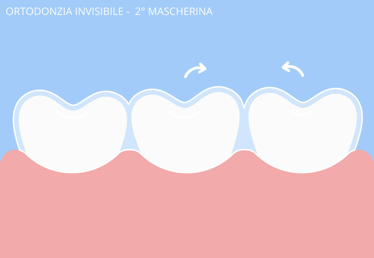 ortodonzia invisibile