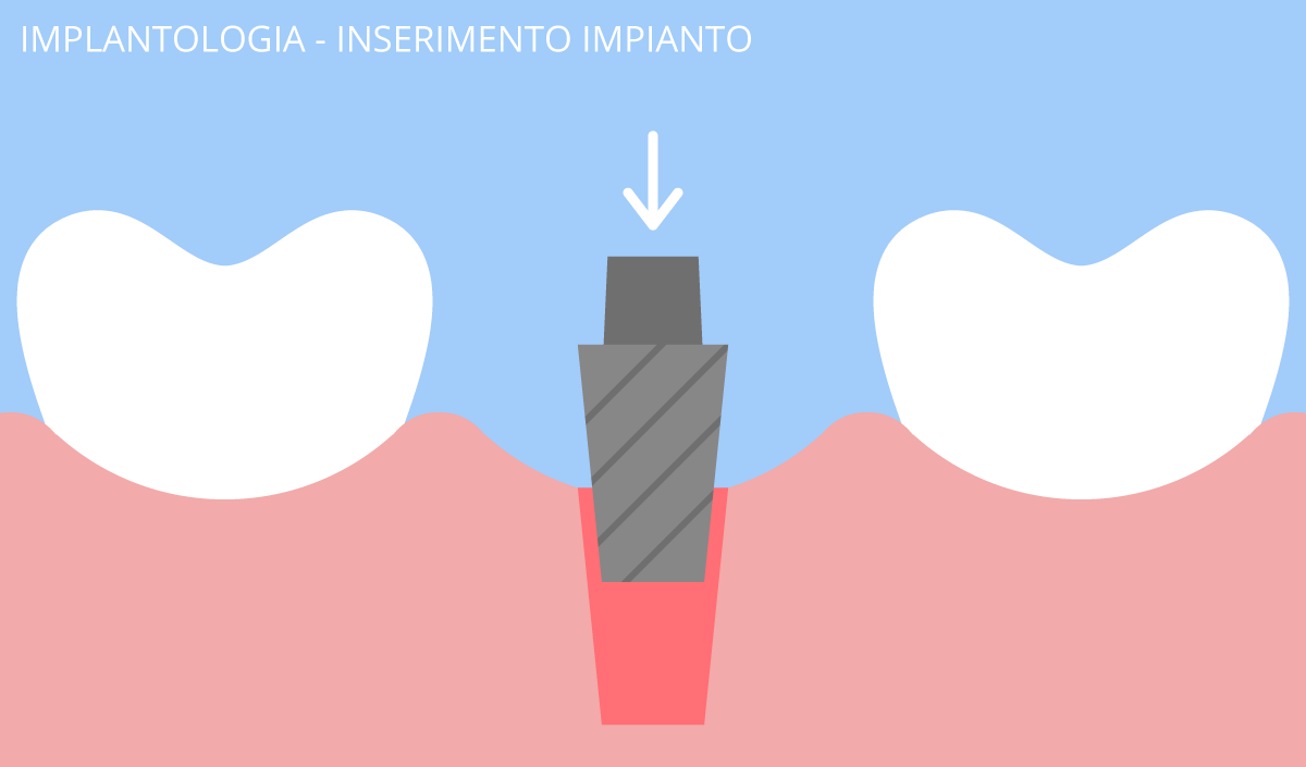 implantologia
