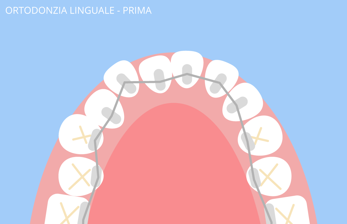 ortodonzia linguale