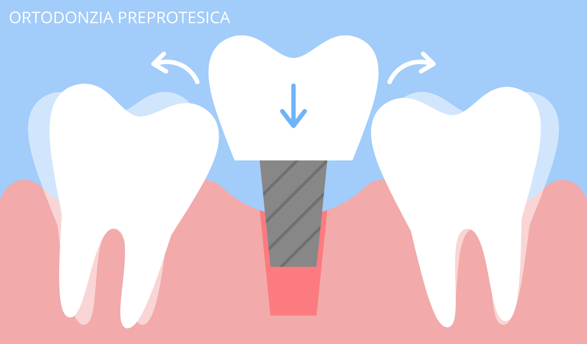 ortodonzia preprotesica