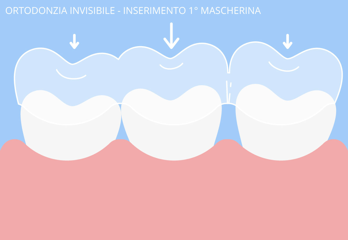 ortodonzia invisibile