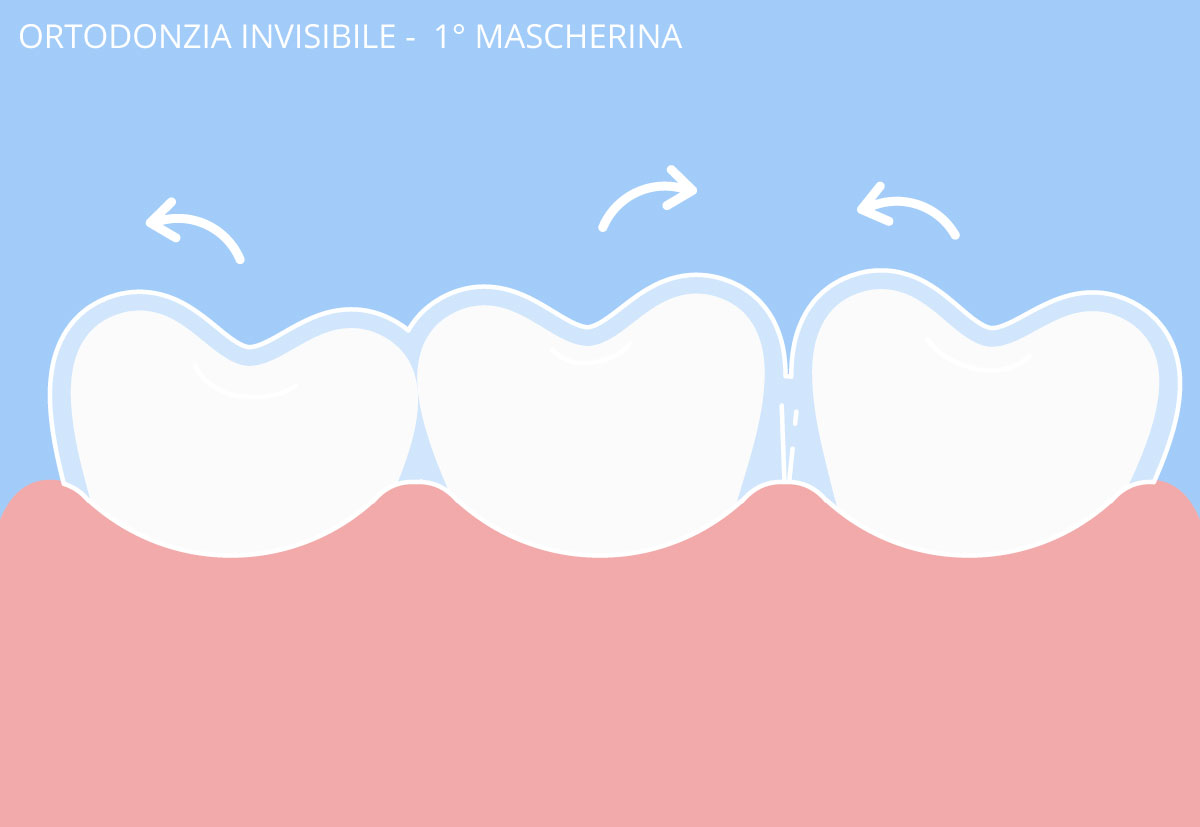 ortodonzia invisibile
