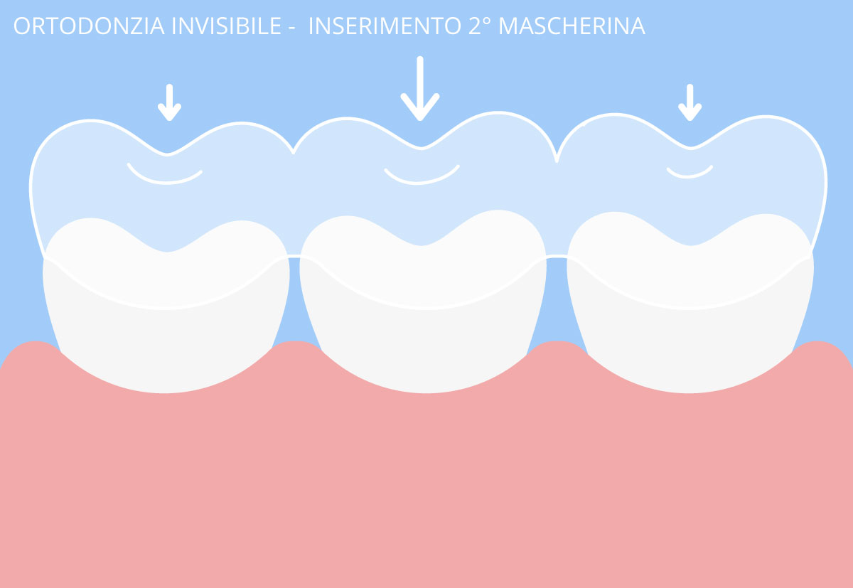 ortodonzia invisibile