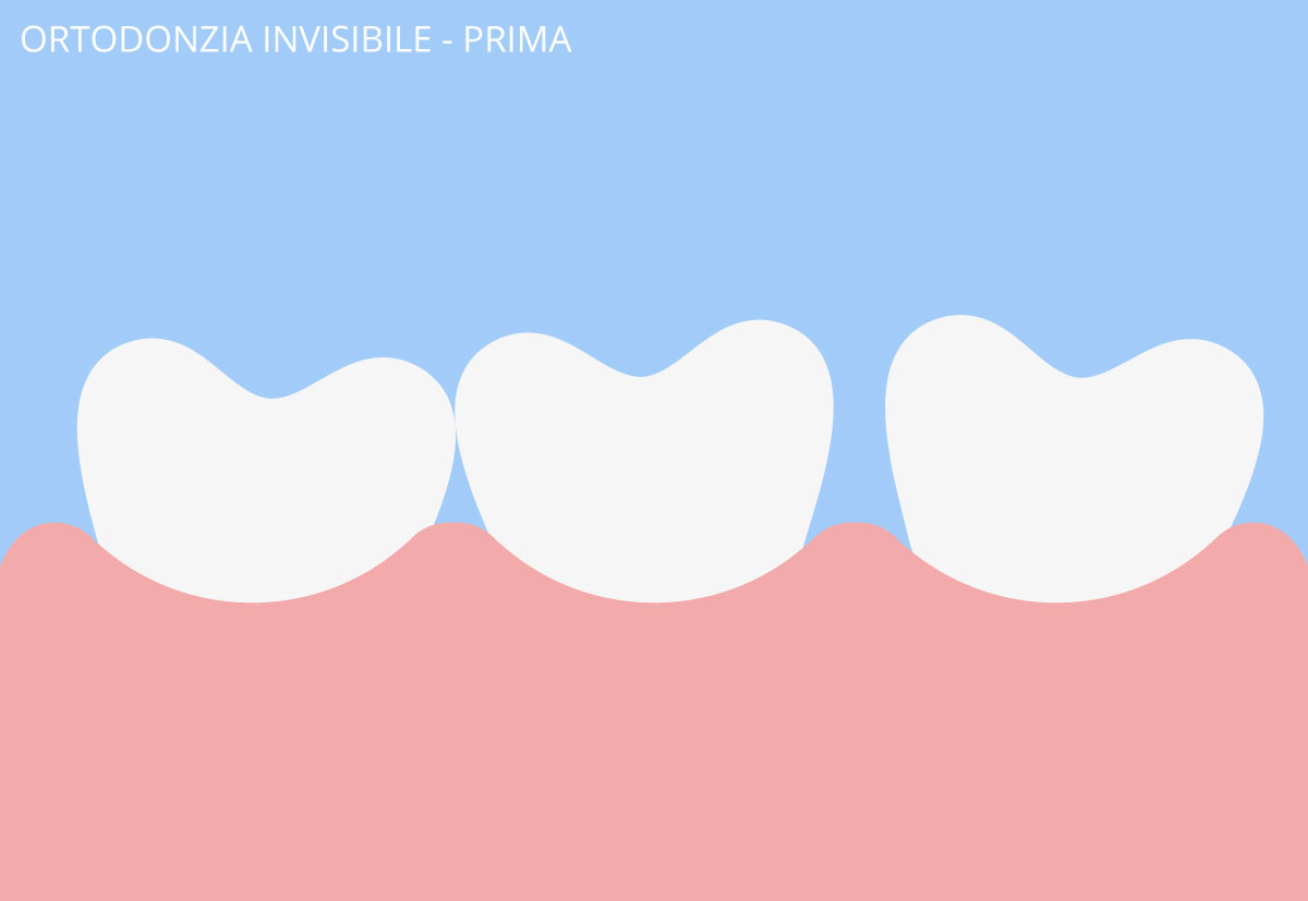 ortodonzia invisibile