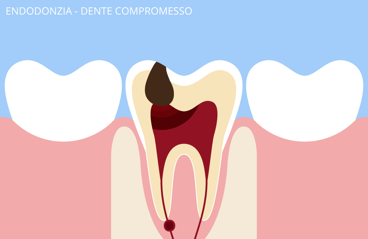 endodonzia