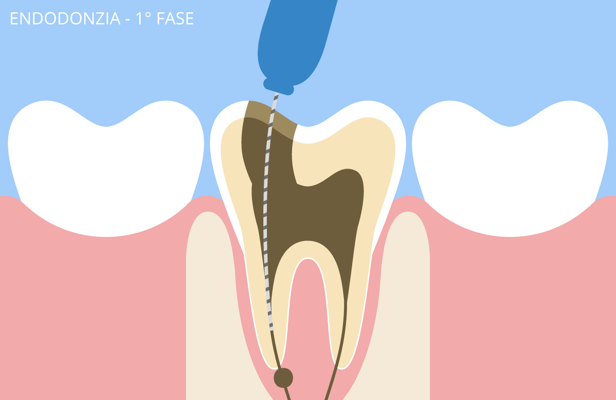 endodonzia