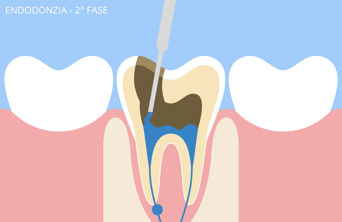 endodonzia