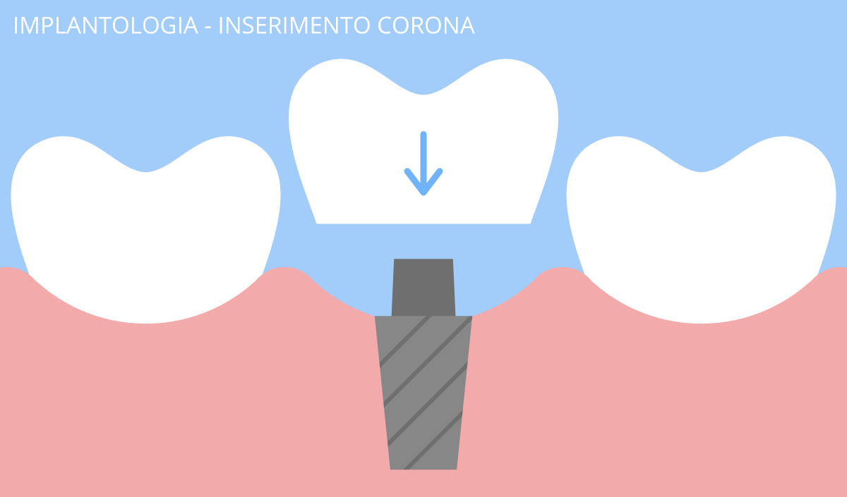 implantologia