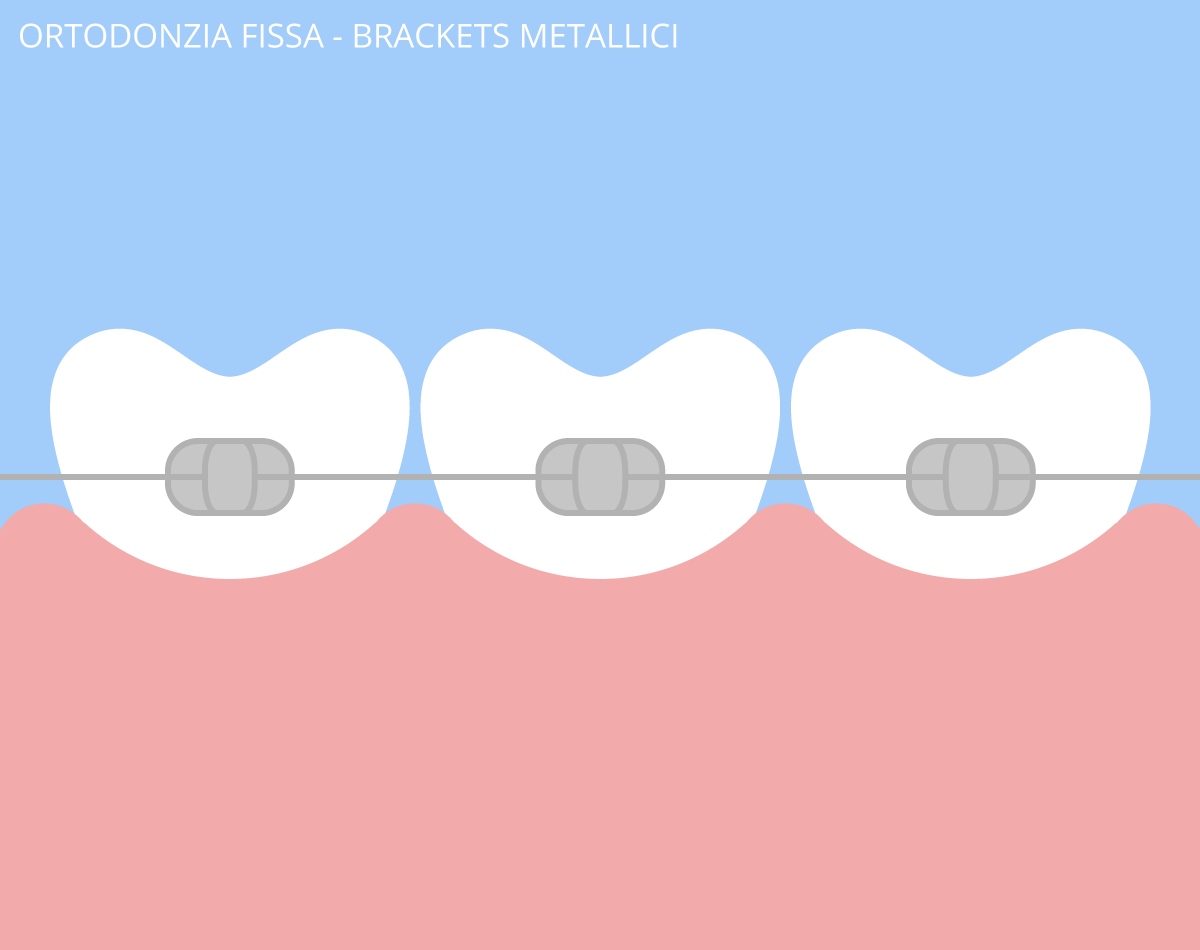 ortodonzia fissa