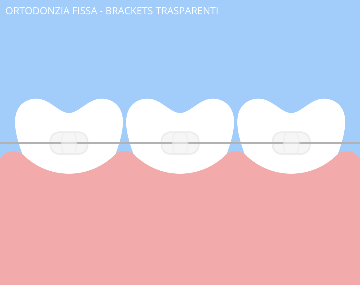 ortodonzia fissa