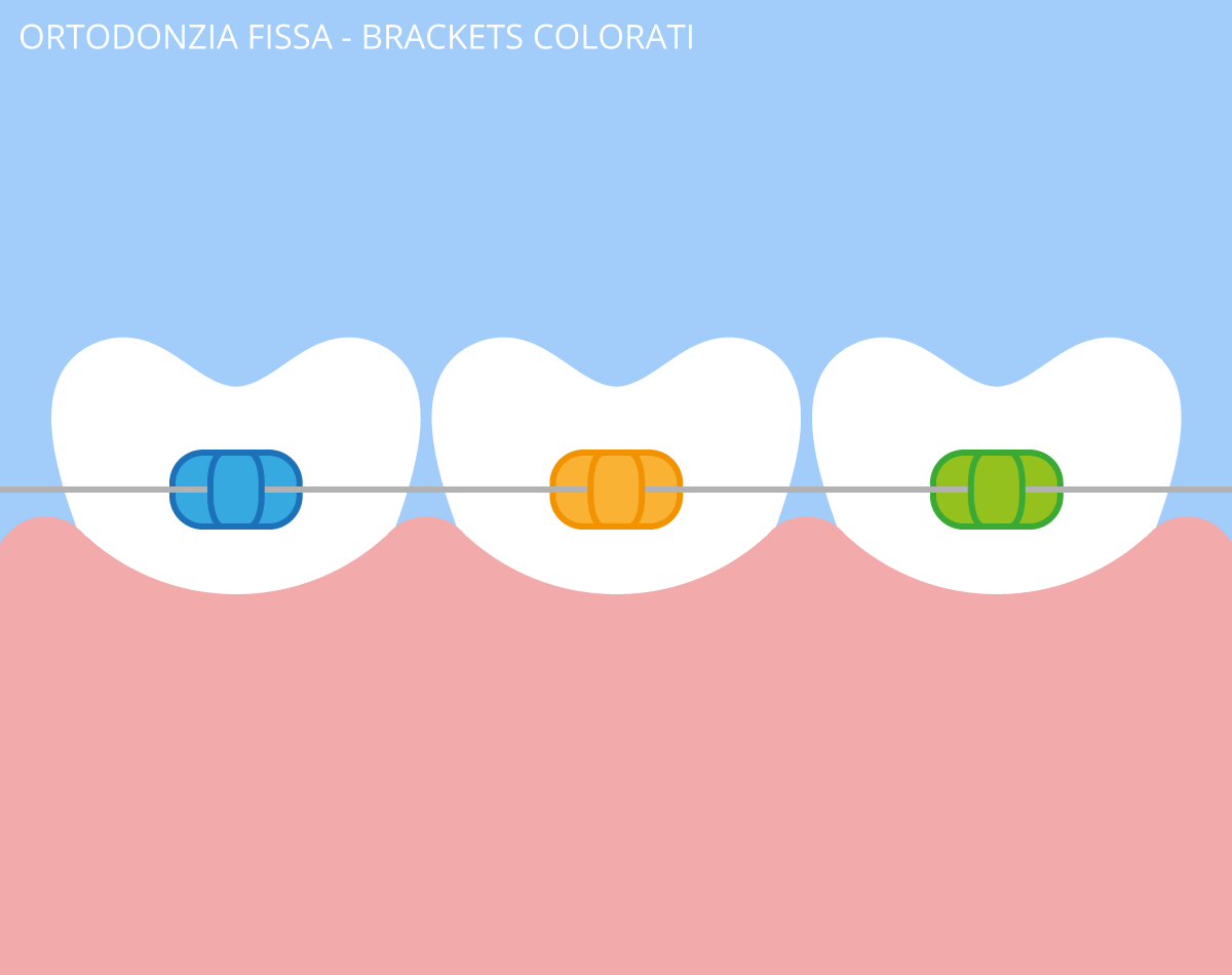 ortodonzia fissa