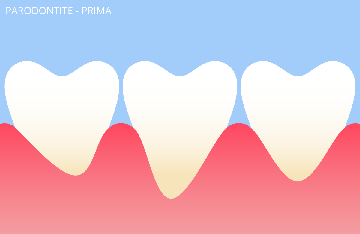 parodontite
